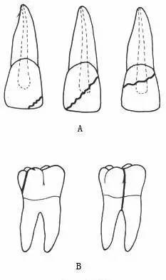 冠折: 前牙可分为 横折和斜折;后牙可分为 斜折和纵折.